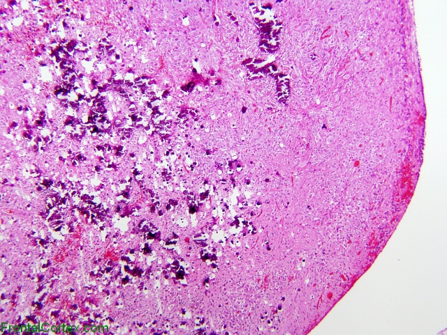 Subependymal giant cell astrocytoma, H&E stain x 40